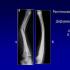 Когда разрабатывать колено после остеотомии: особенности операции и реабилитации