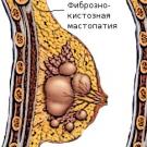 Месячные при мастопатии Медикаментозное лечение мастопатии