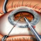 5 катаракта надо ли делать операцию